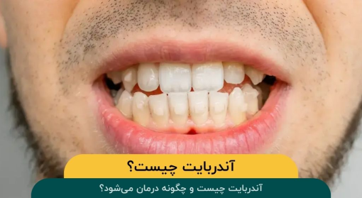 آندربایت-چیست